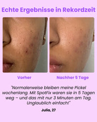 Luvely Spotfix™ | Gezielte Behandlung für unerwartete Pickel
