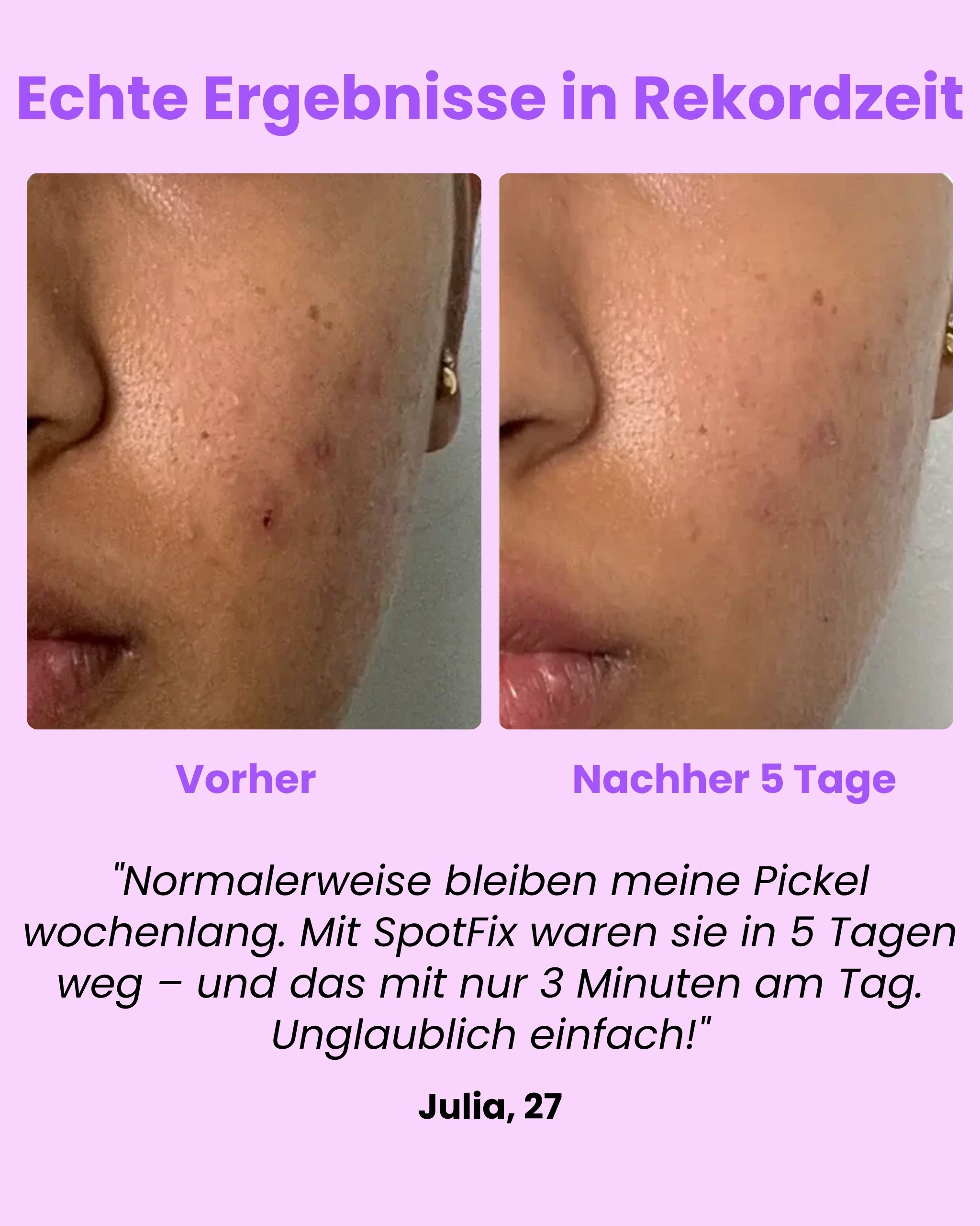 Luvely Spotfix™ | Gezielte Behandlung für unerwartete Pickel