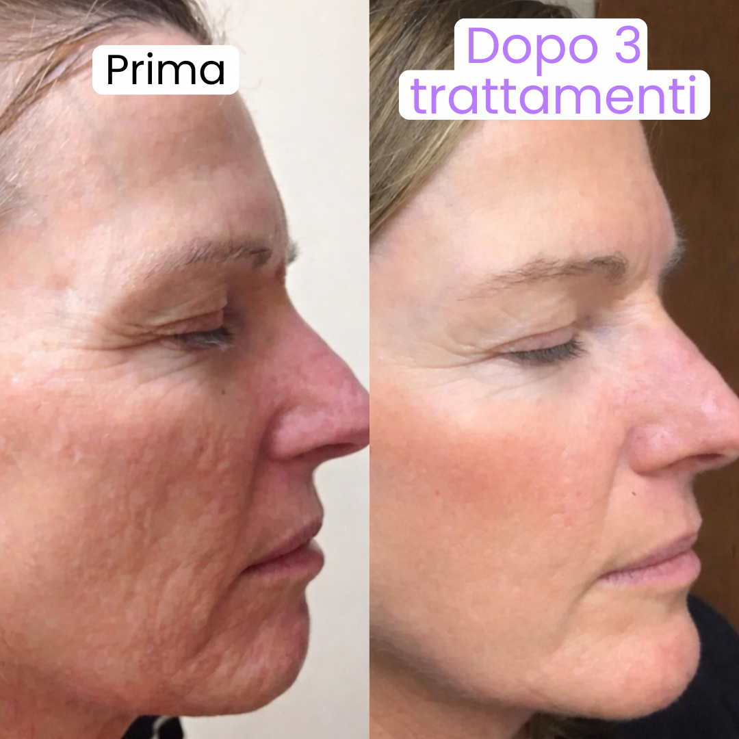 Luvely Infusion™ | Trattamento anti-età a microinfusione