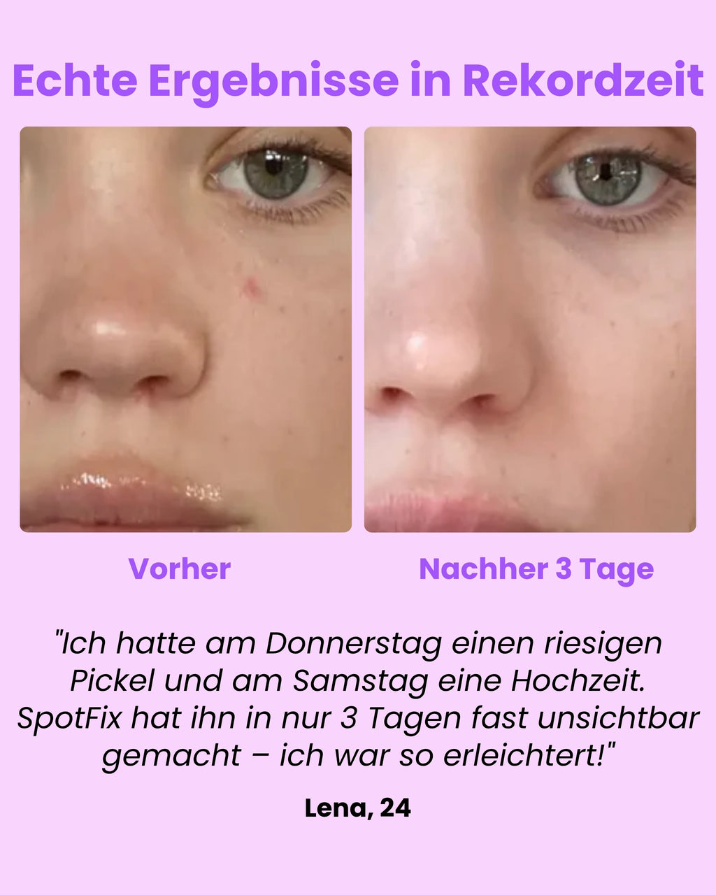 Luvely Spotfix™ | Gezielte Behandlung für unerwartete Pickel