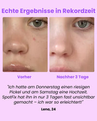 Luvely Spotfix™ | Gezielte Behandlung für unerwartete Pickel
