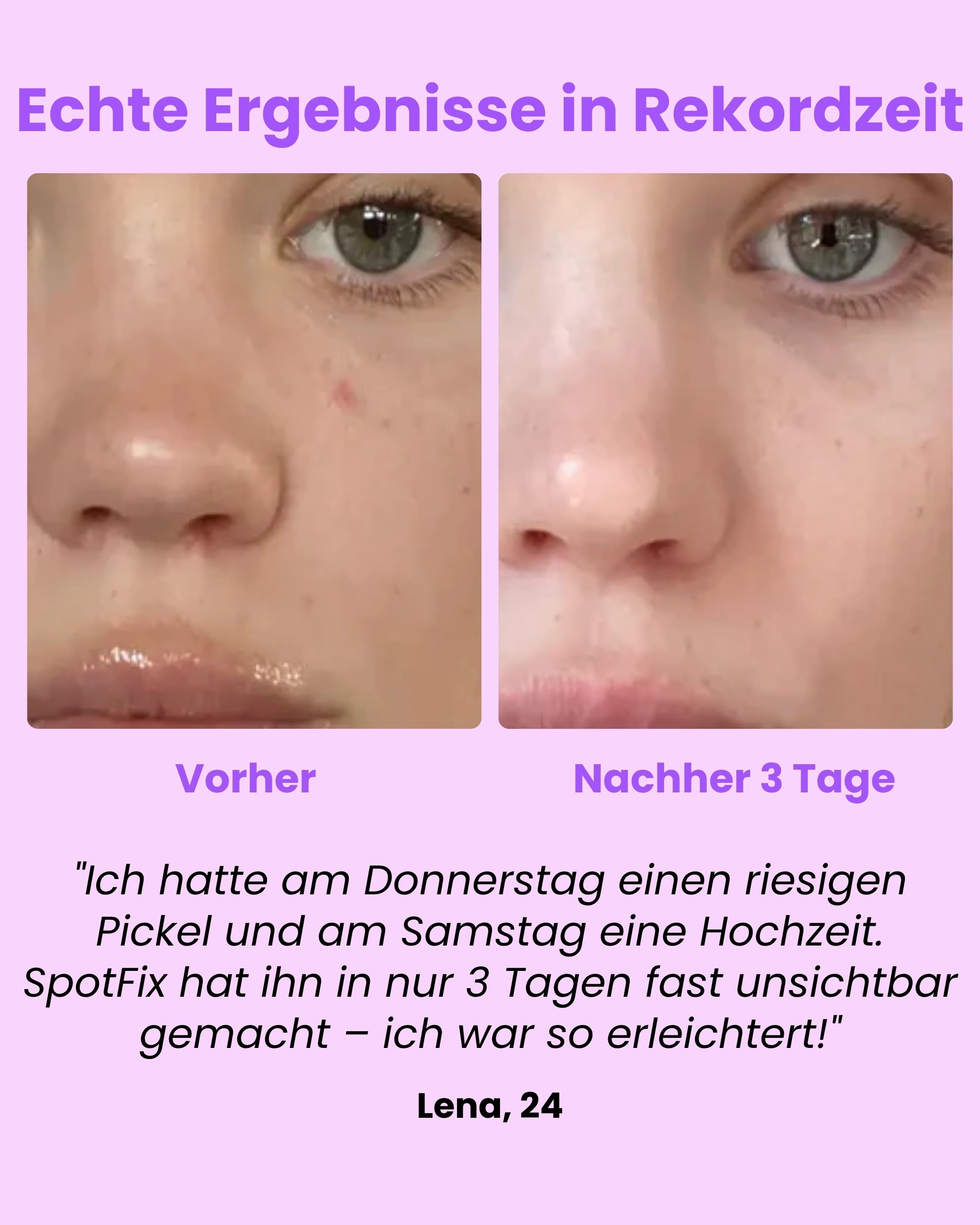 Luvely Spotfix™ | Gezielte Behandlung für unerwartete Pickel