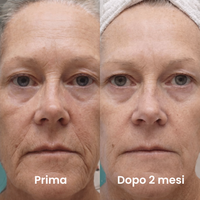 Luvely Infusion™ | Trattamento anti-età a microinfusione