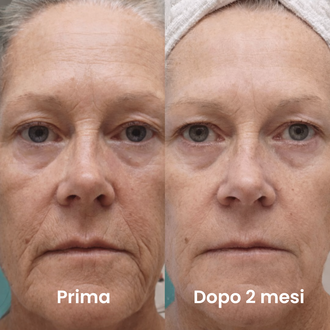 Luvely Infusion™ | Trattamento anti-età a microinfusione